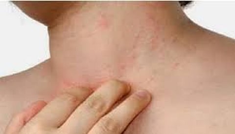 مستقبل مكافحة داء الدرن العالمي: كيف نتغلب على الأزمات؟