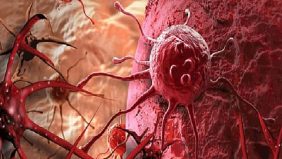 علماء روس يبتكرون تقنية حديثة لتدمير الخلايا السرطانية